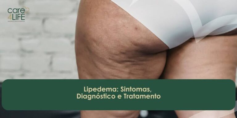 Lipedema: Sintomas, Diagnóstico e Tratamento