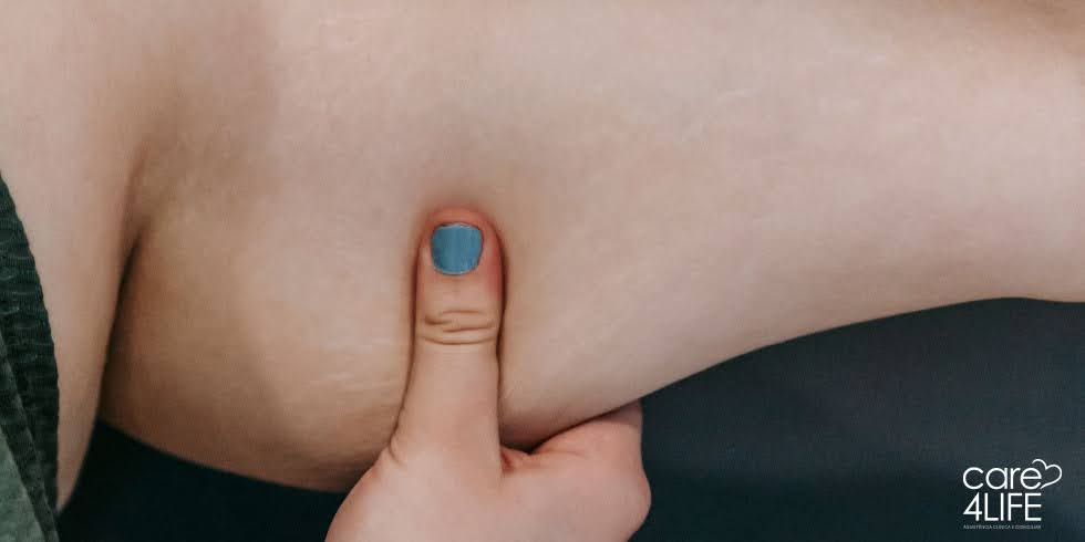 Lipedema: Sintomas, Diagnóstico e Tratamento
